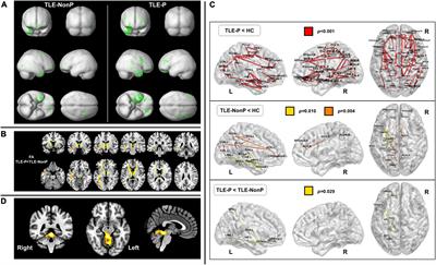 Neurobiological mechanisms of psychosis in epilepsy: Findings from neuroimaging studies